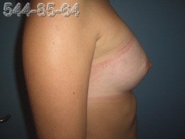 Операция по увеличению груди - Фото ПОСЛЕ операции