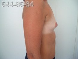 Операция по увеличению груди - Фото ДО операции